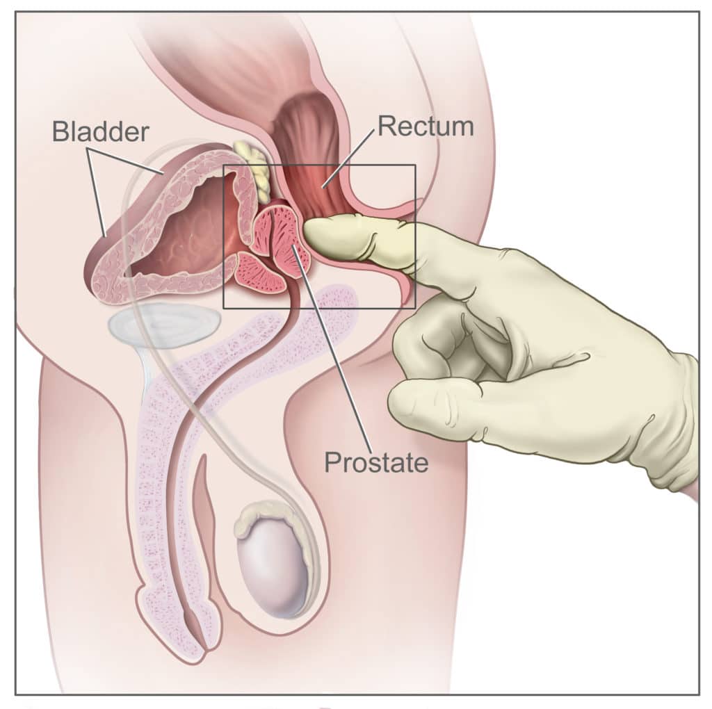 CDR457840 digital rectal exam